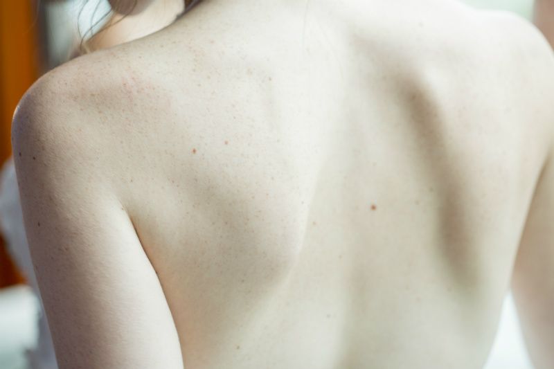 Problemas de espalda, hernia discal