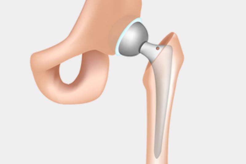 materiales y tipos de protesis de cadera en elgeadi traumatologia