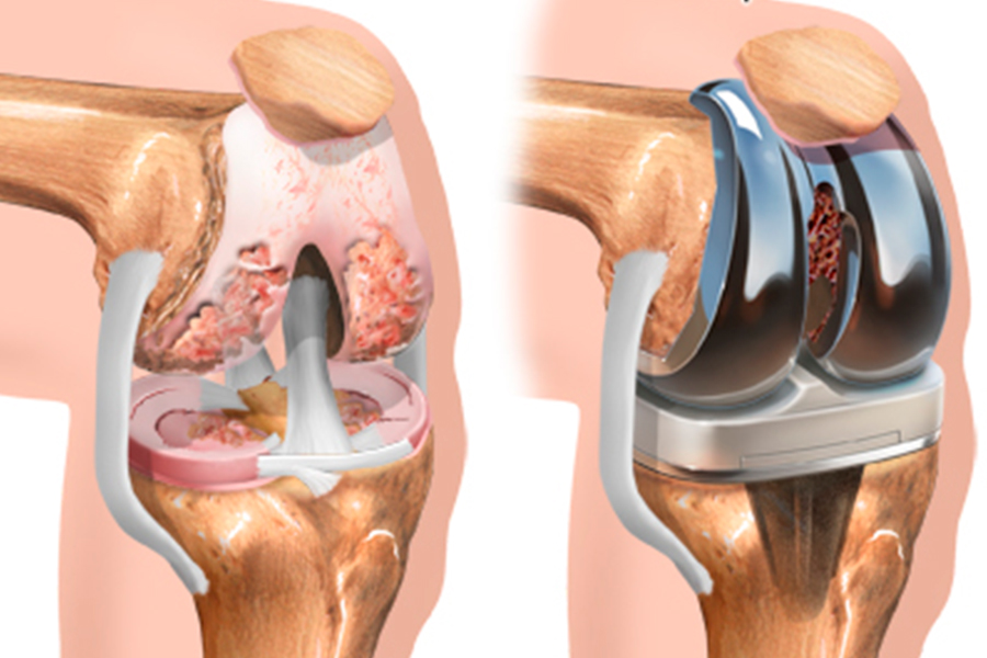 Complicaciones-tras-la-implantación-de-una-prótesis-de-rodilla